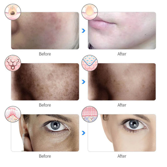 SkinAura™ – Masque de Luminothérapie Professionnel LED